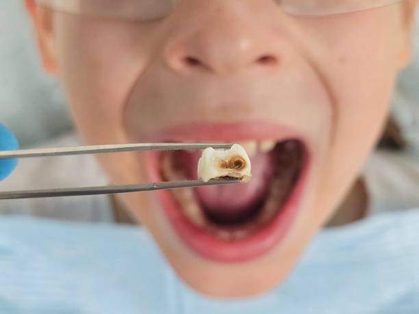 Best Knocked-Out Tooth Emergency  in Carter, TX